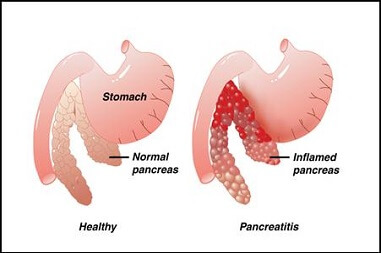 image showing a good pancreas beside a bad pancreas, indicative of pancreatitis in dogs